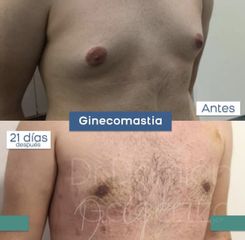 Ginecomastia - Dr. Damián Galeazzo