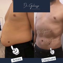 Abdominoplastía con Renuvion - Dr. Damián Galeazzo