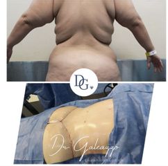 Abdominoplastía 360grados - Dr Galeazzo