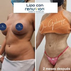 Lipoescultura - Dr. Damián Galeazzo y Equipo