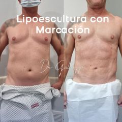 Lipoescultura - Dr. Damián Galeazzo y Equipo