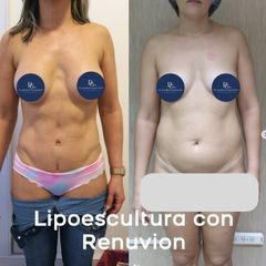 Lipoescultura con Renuvion