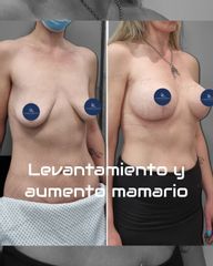 Levantamiento mamario - Dr. Damián Galeazzo y Equipo
