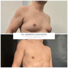 Ginecomastia - Dr. Damian Galeazzo