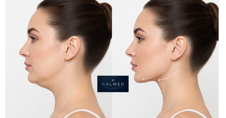 Lipopapada - Galeazzo Cirugia & Estetica