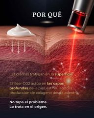 Láser Co2 - Dr Galeazzo Cirugía Plástica | Galmed
