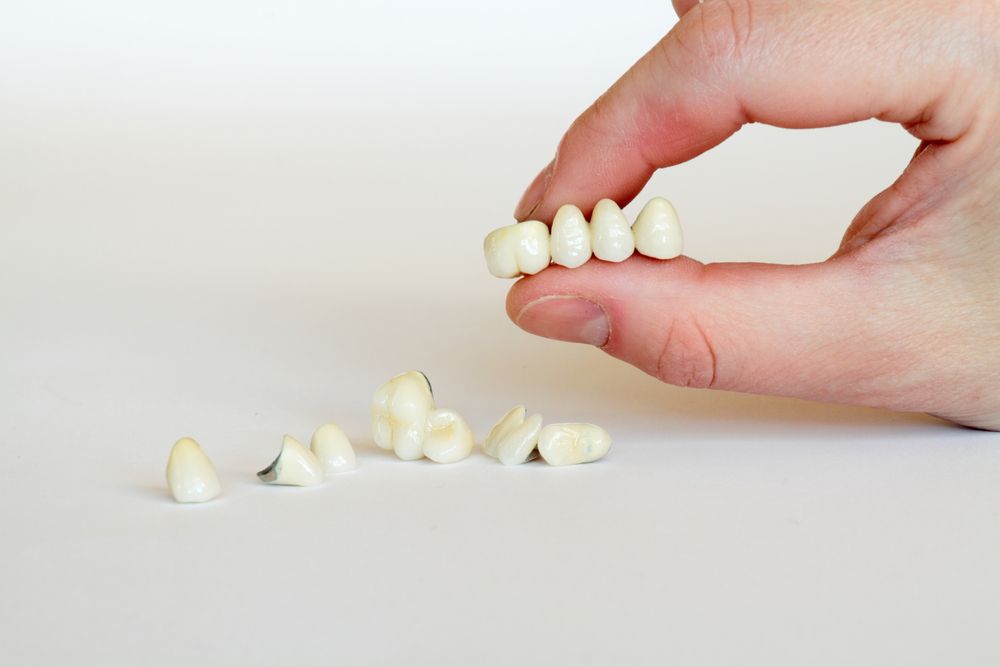 persona sosteniendo implantes dentales