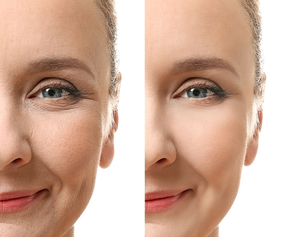 Antes y después de un tratamiento de rejuvenecimiento facial