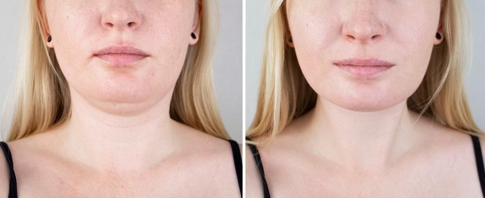 Mujer rubia antes y después de hacer un tratamiento de reducción de papada