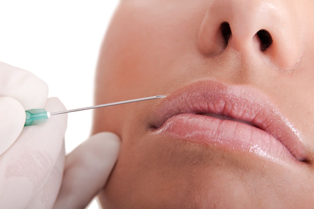 Mujer recibiendo relleno facial en los labios