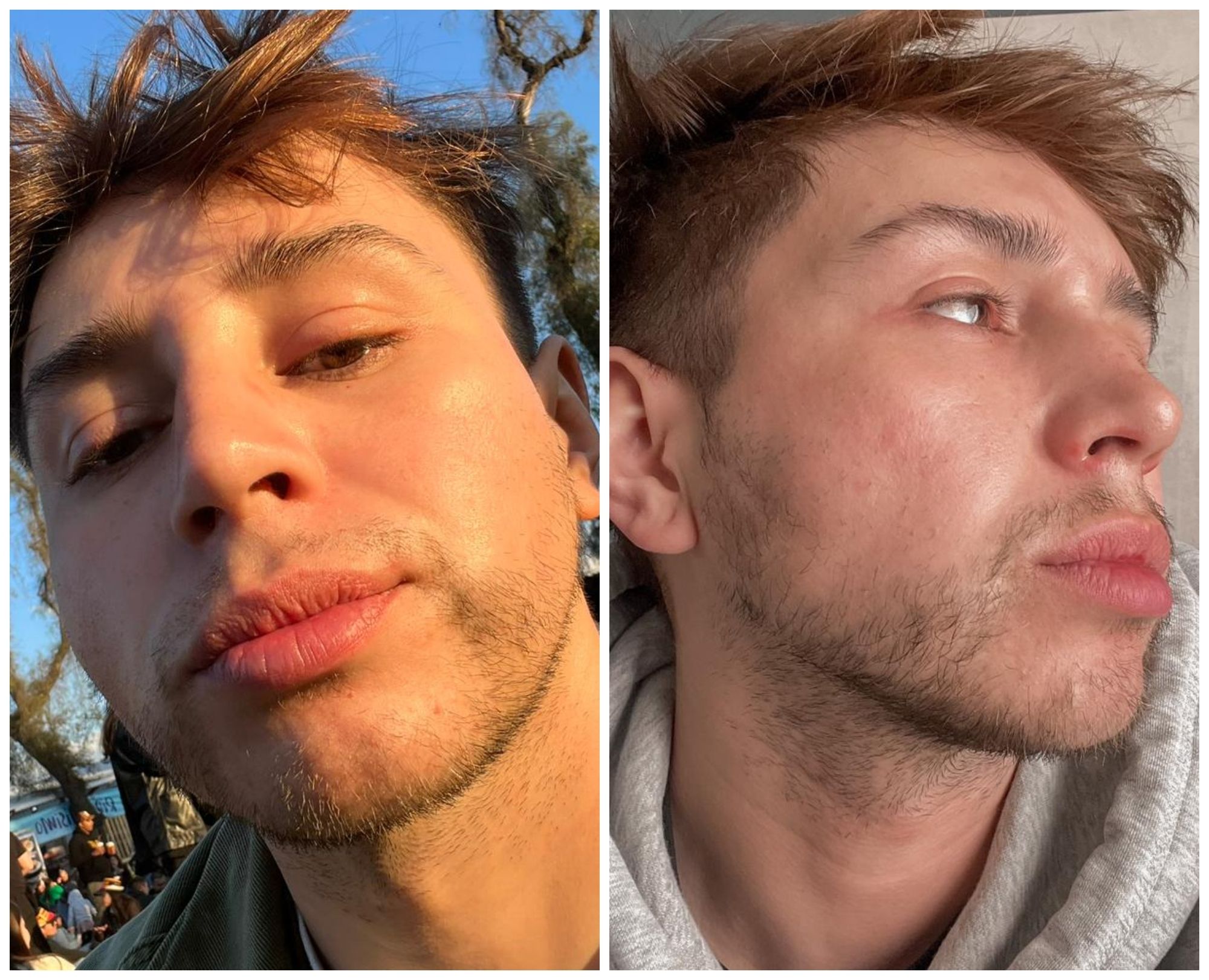 Antes y después de un tratamiento lipolítico