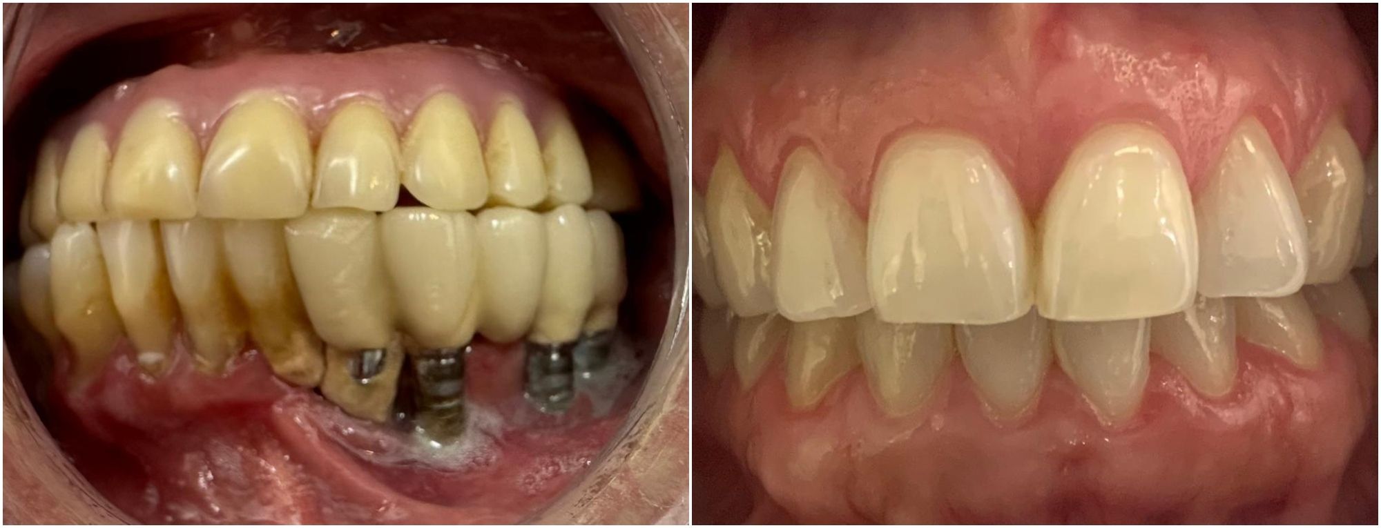 Dentadura antes y después de implantes dentales
