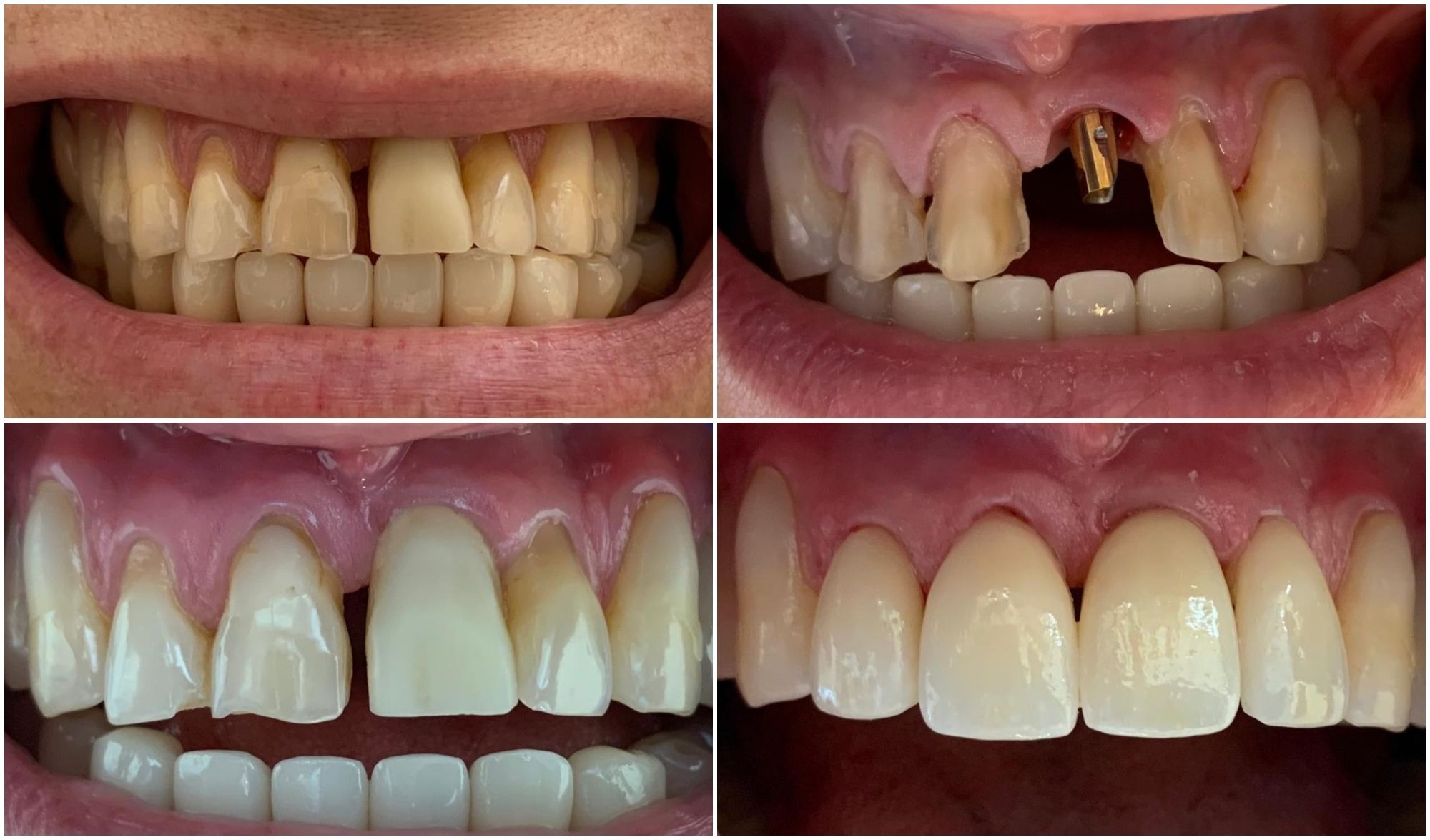 Antes y después de los implantes dentales