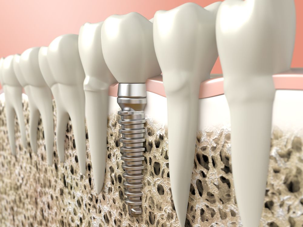 diseño 3D de un implante dental