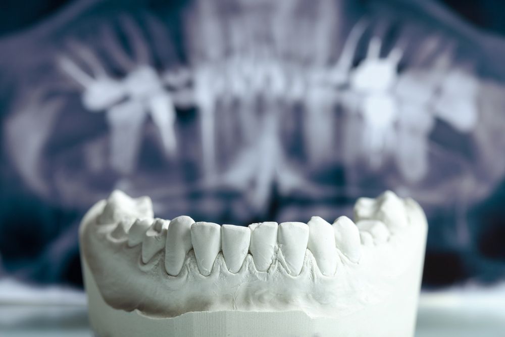 foto de un molde de dentadura usado para hacer una prótesis