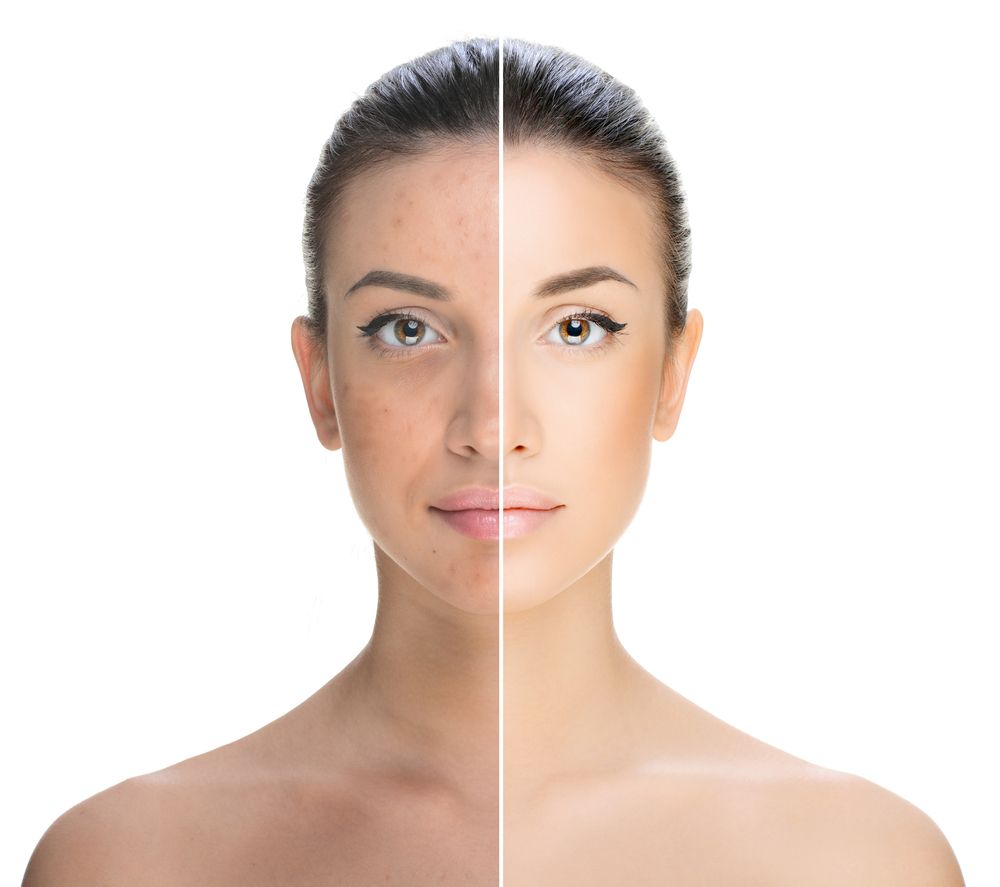 antes y después de un tratamiento facial