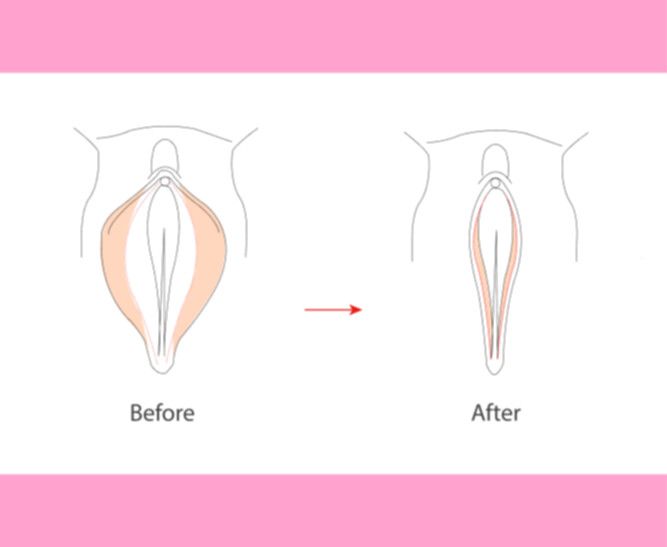 vagina antes y después de una vaginoplastia