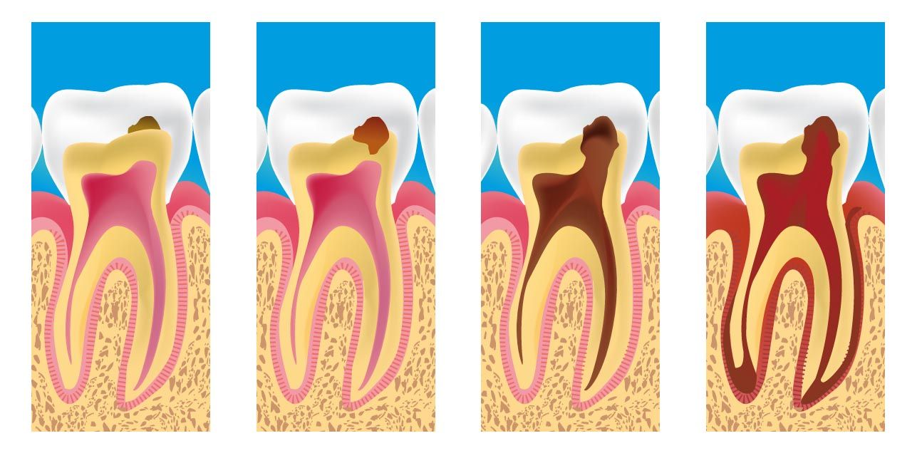 Foto de procesos de desarrollo de una carie en un diente