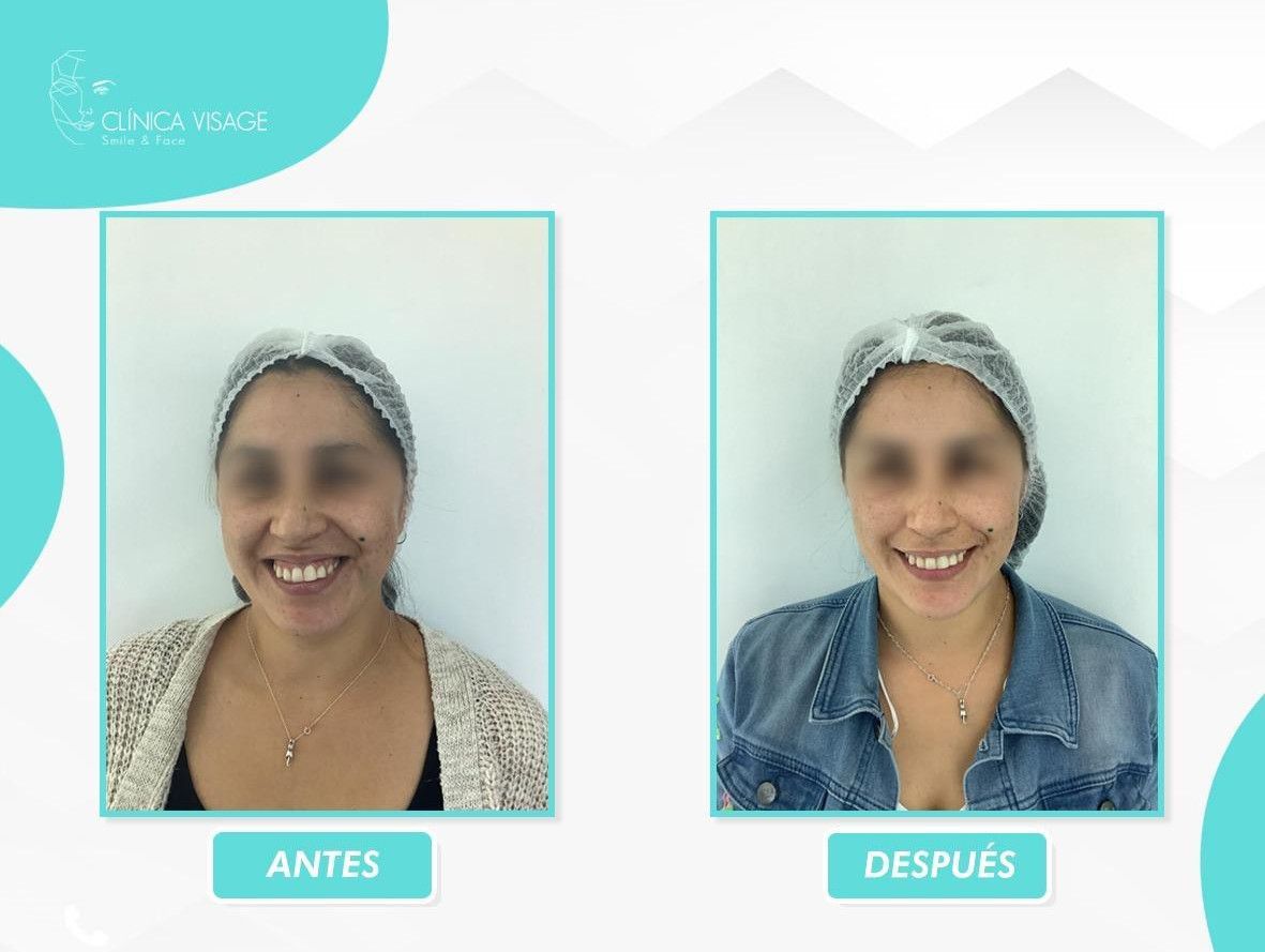 Antes y después de un tratamiento de sonrisa gingival