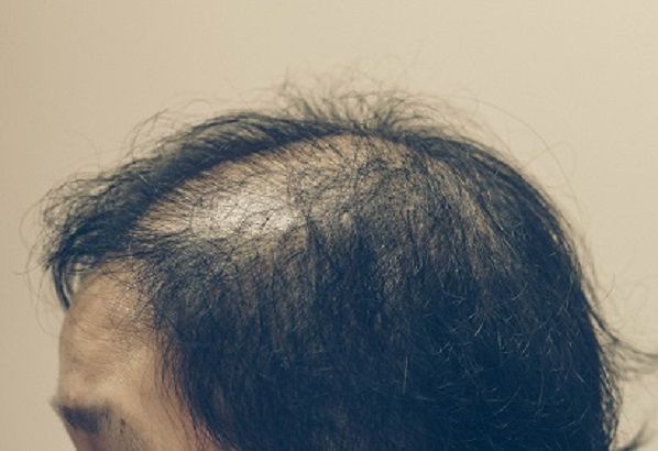 Personas con problema de alopecia