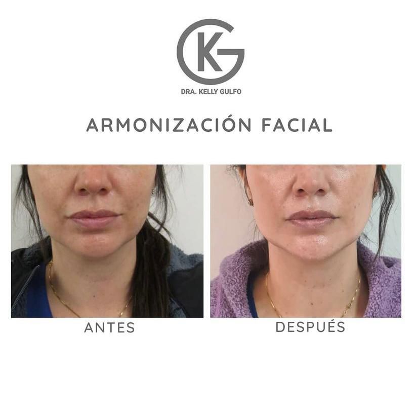 Antes y después de la armonización facial