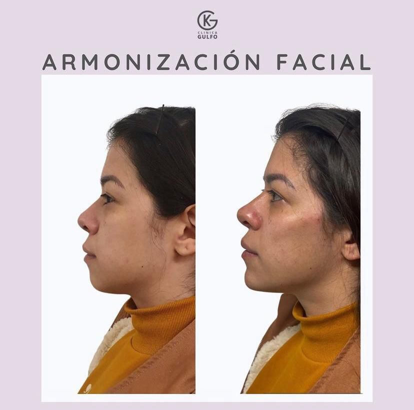 Antes y después de una armonización facial