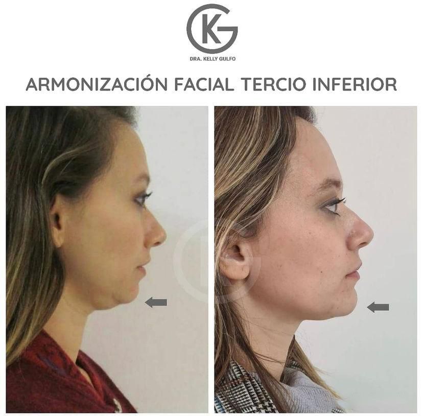 Antes y después de armonización facial