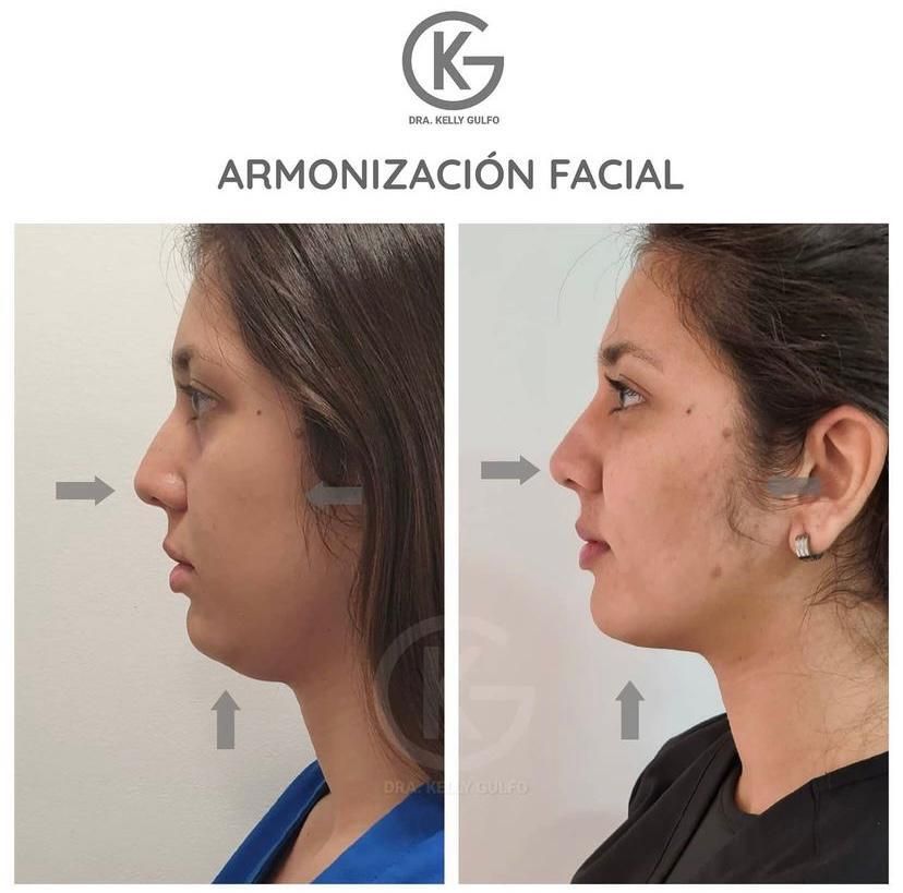 Antes y después de una armonización facial