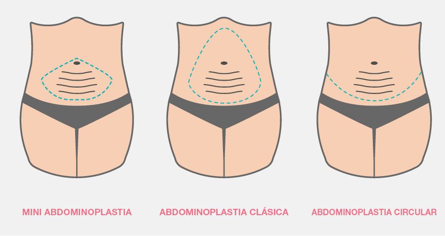 Diferentes tipos de abdominoplastia