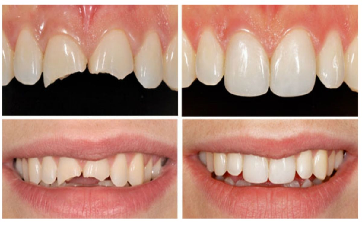 Antes y después de una reconstrucción dental