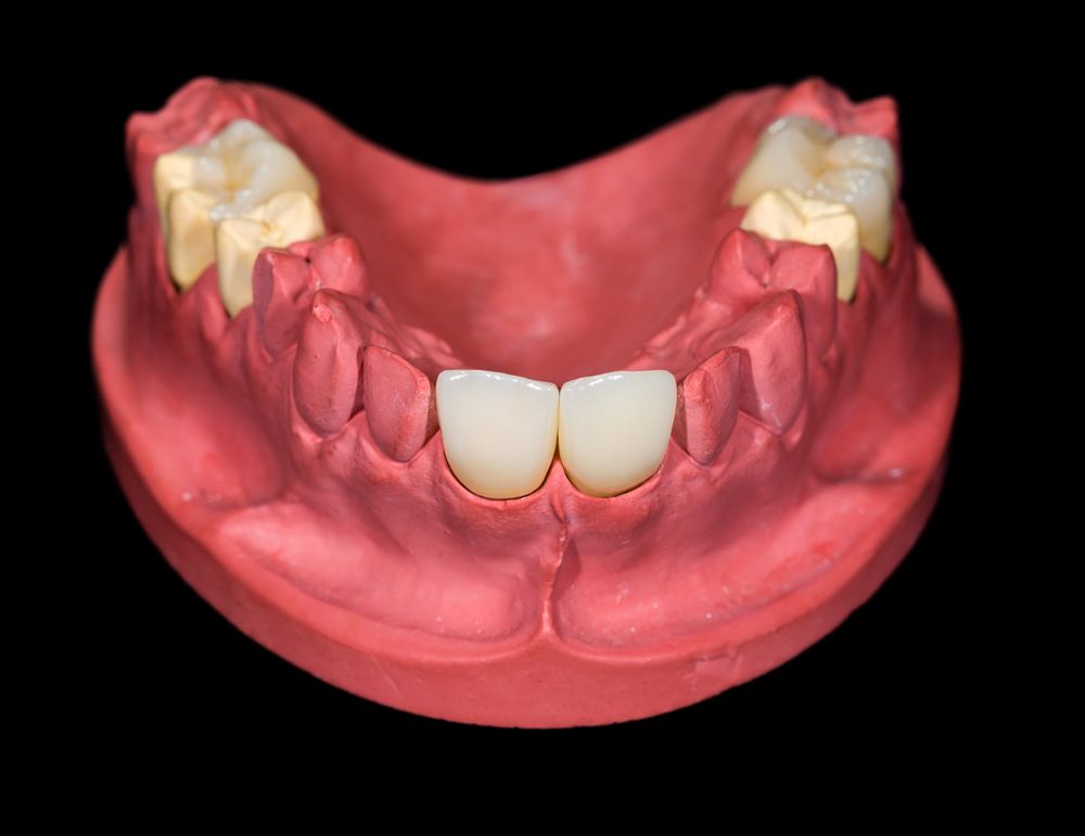 muestra de dientes con incrustación