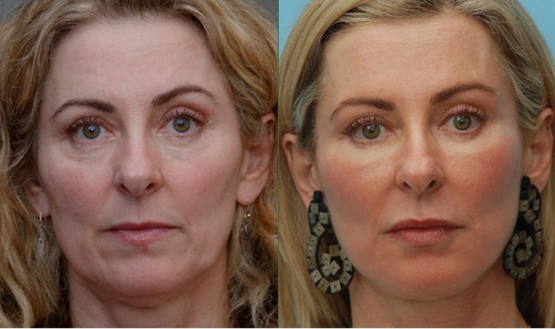 mujer antes y después de un rejuvenecimiento facial