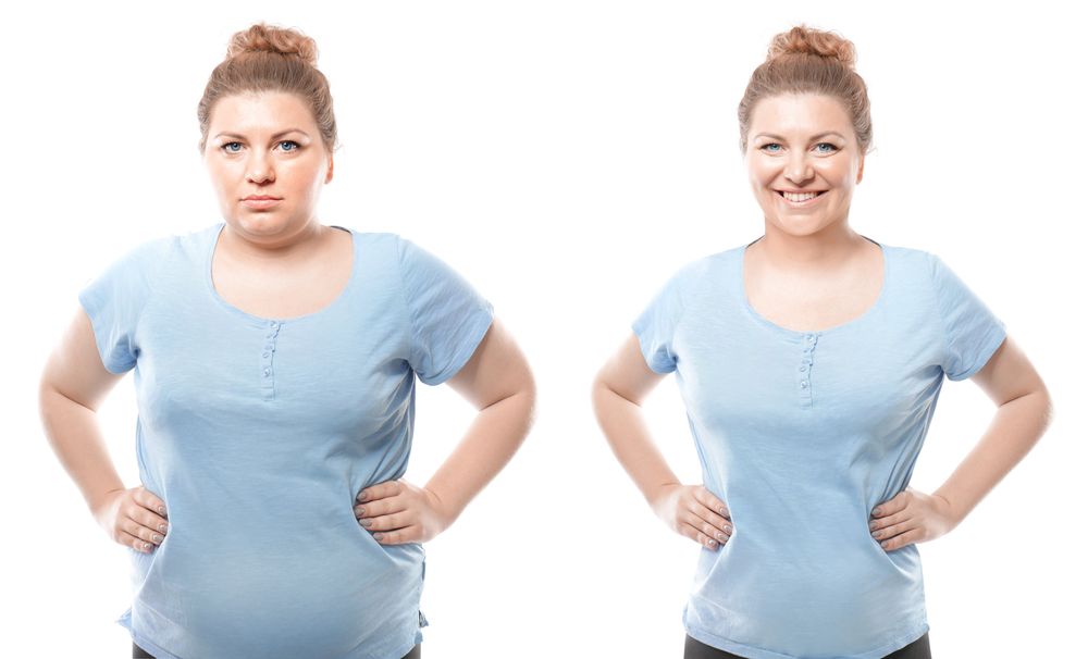 Mujer antes y después de un tratamiento para la obesidad