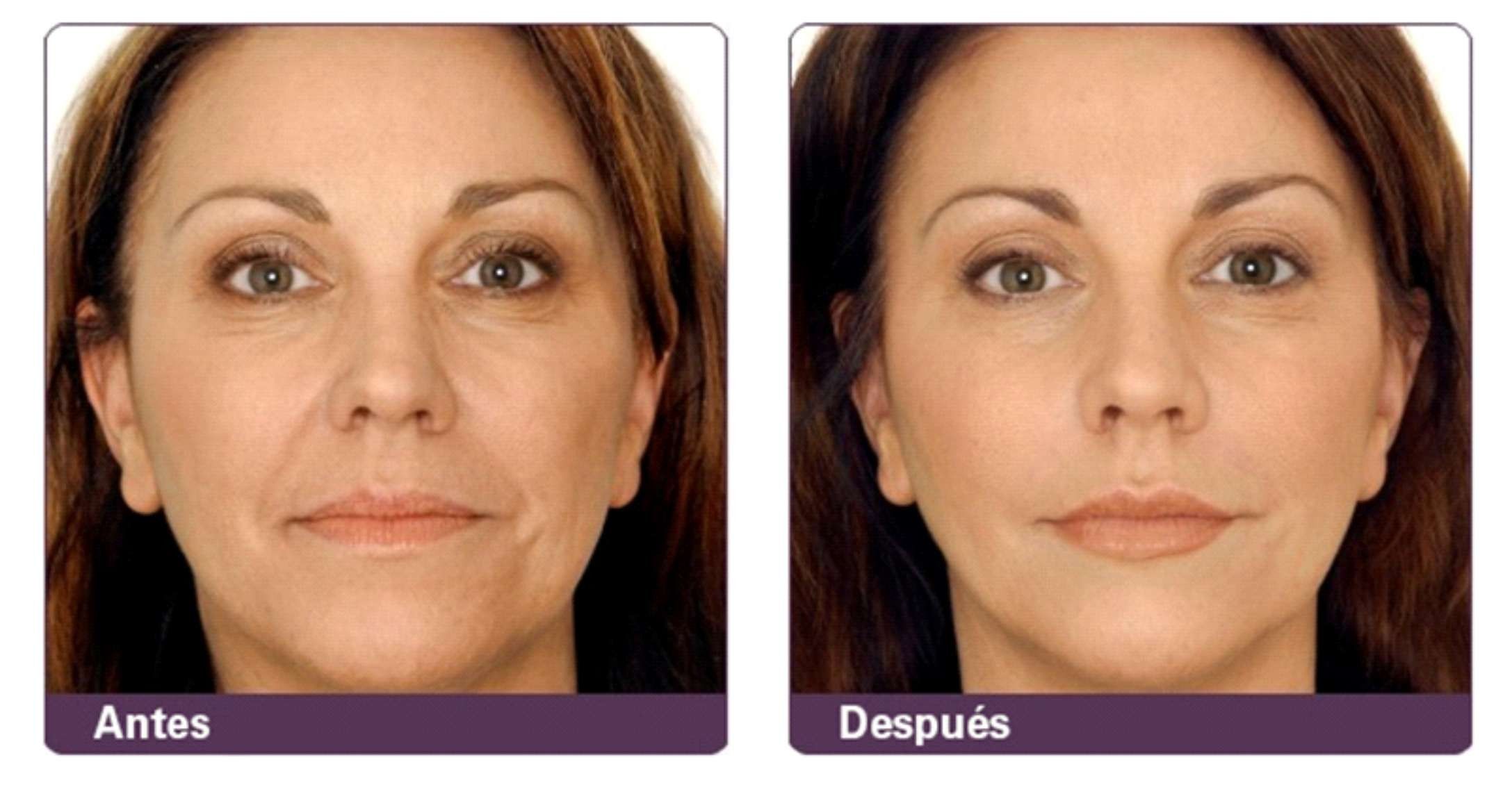 foto de antes y después de un rejuvenecimiento facial