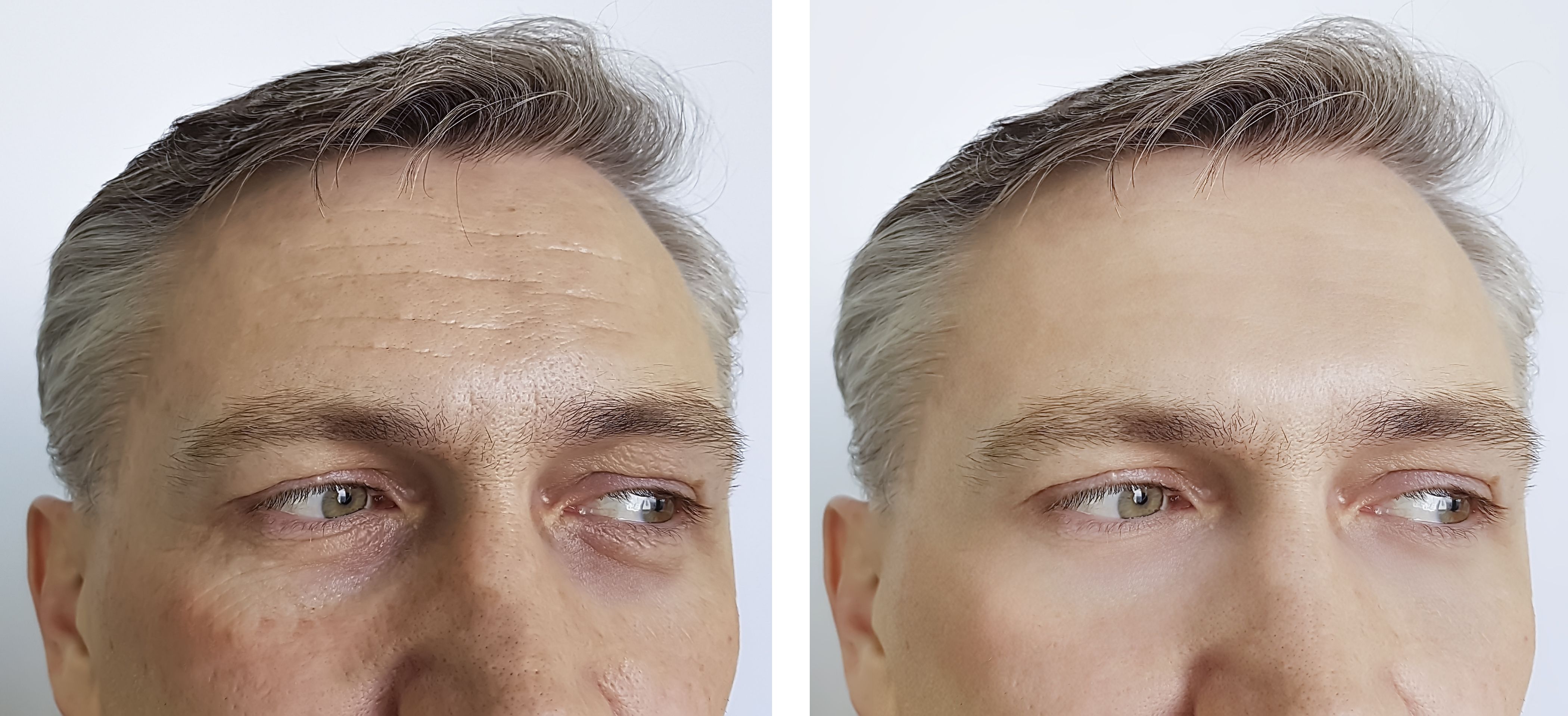 armonización facial masculina
