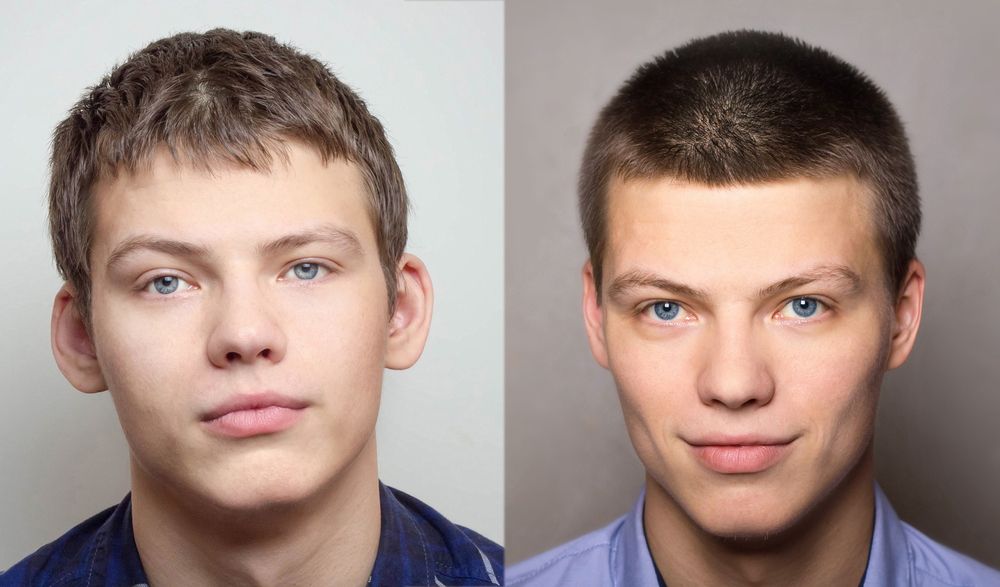 adolescente antes y después de una otoplastia
