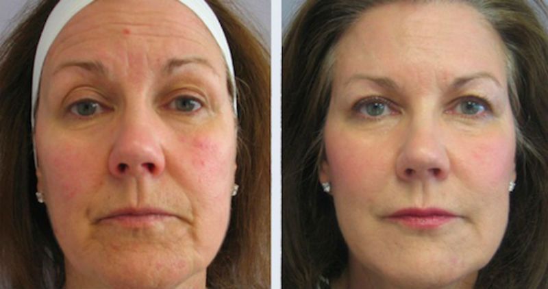 Antes y después de un tratamiento de rejuvenecimient facial