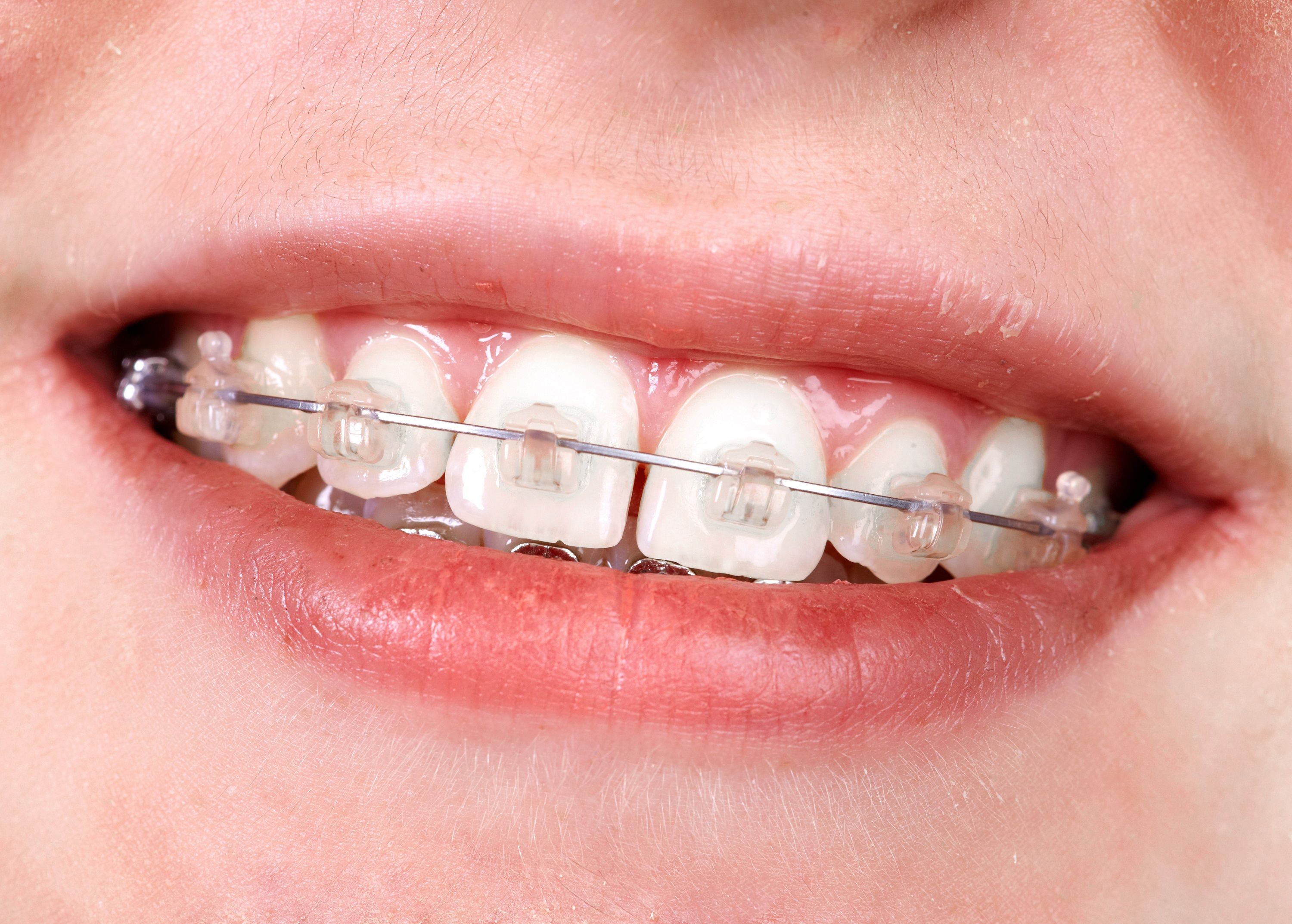 foto de dientes con ortodoncia