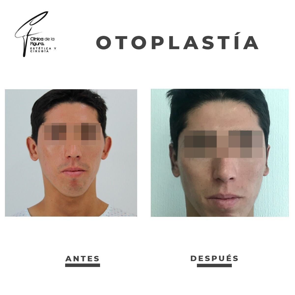 Rostro de un hombre antes y después de la otoplastia