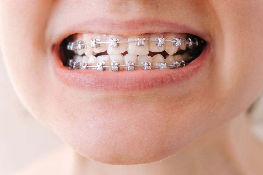 Persona mostrando frenillo fijos en sus dientes