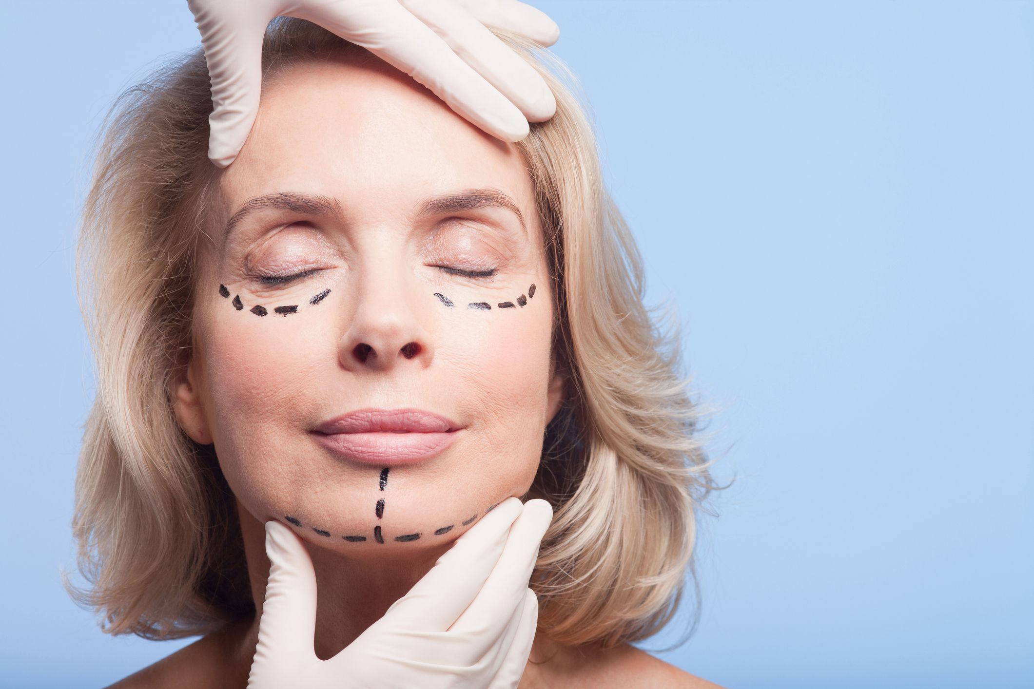 Mujer rubia con marcas en la cara de donde se le hará la cirugía