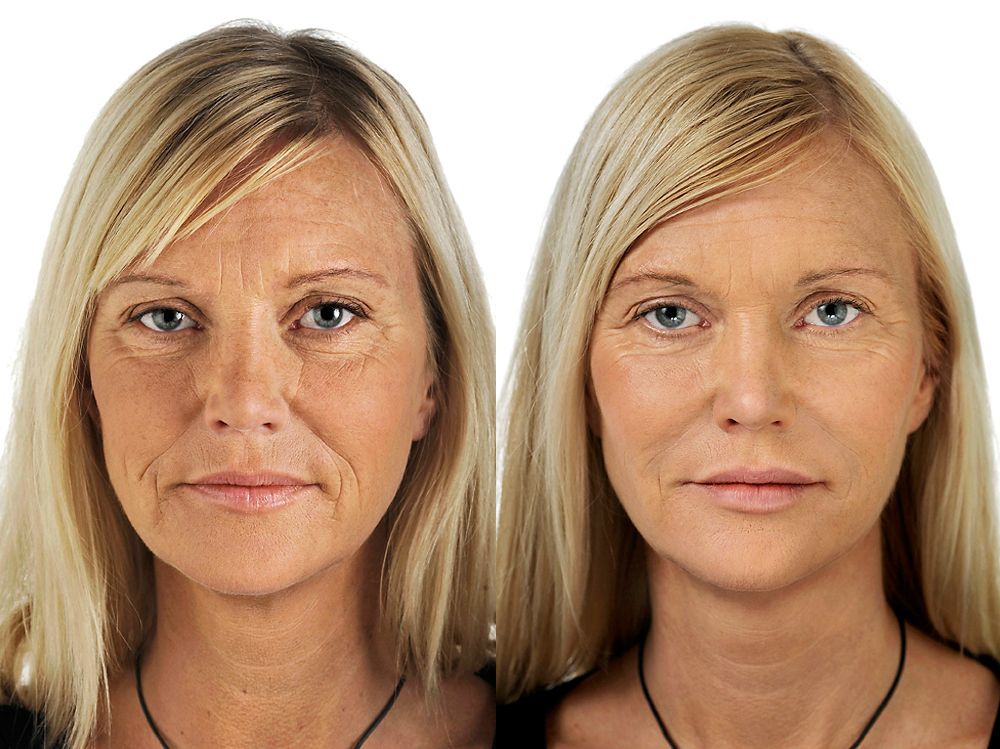 mujer antes y después del rejuvenecimiento facial