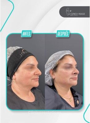 Full face antes y despues