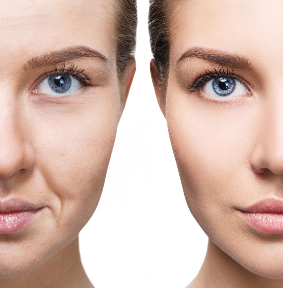 Antes y después de un tratamiento en el rostro