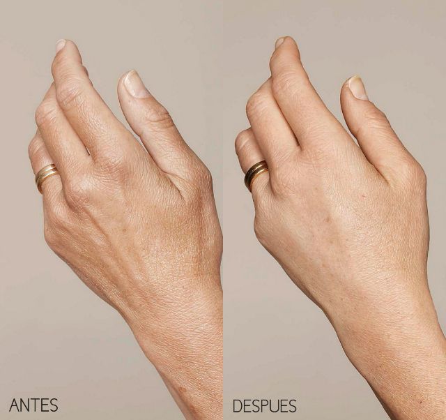 foto de mano antes y después del rejuvenecimiento estético