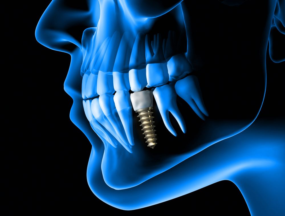 foto de implante dental