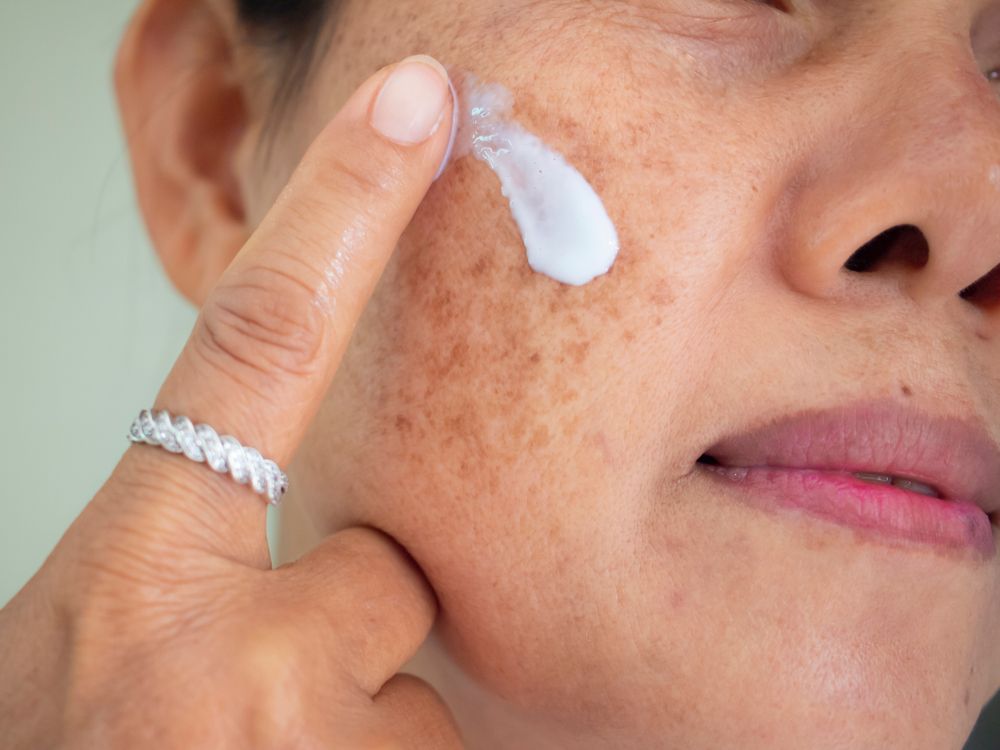 mujer se aplica crema en las manchas de su rostro