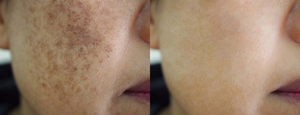 rostro de mujer Antes y después de un tratamiento para manchas