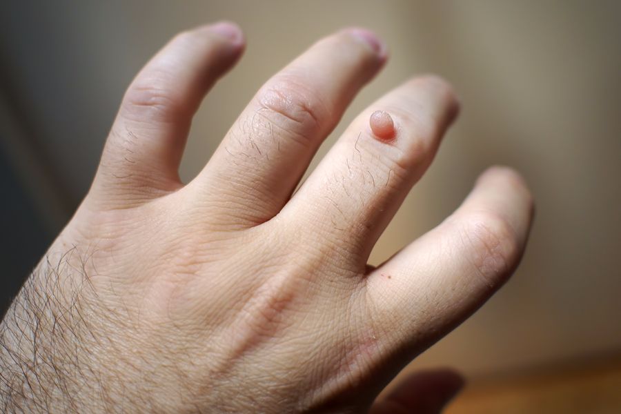 Mano de una persona con una verruga en el dedo