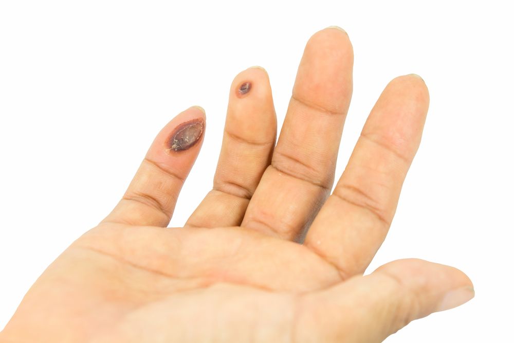foto de mano con verrugas en los dedos